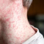 sarampión 2152300024